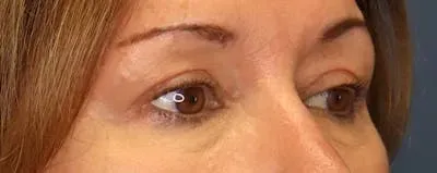 Upper Blepharoplasty #11 after