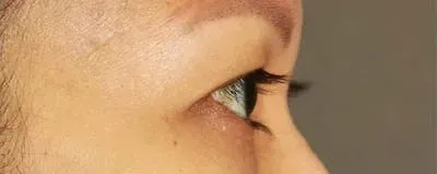 Upper Blepharoplasty #1 before