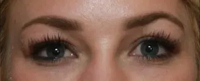 Upper Blepharoplasty #5 before