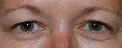 Upper Blepharoplasty #2 before