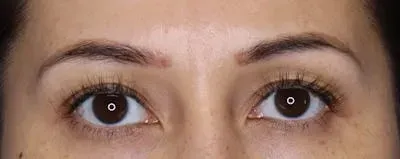 Upper Blepharoplasty #3 before
