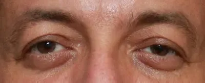 Upper Blepharoplasty #10 before