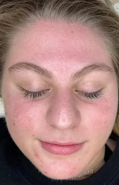 Acne Treatment #3 after