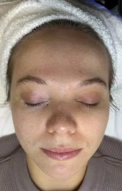 Acne Treatment #1 after