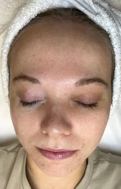 Acne Treatment #1 before