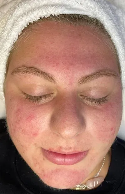 Acne Treatment #3 before