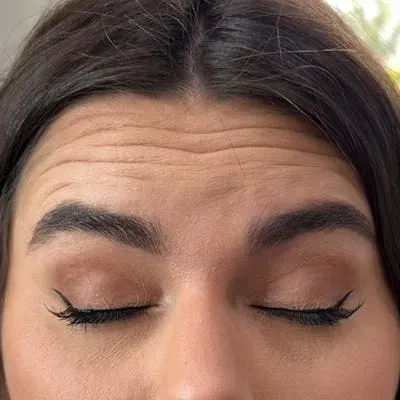 Botox #2 before