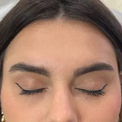 Botox #2 after