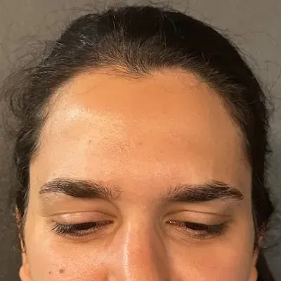 Botox #1 after