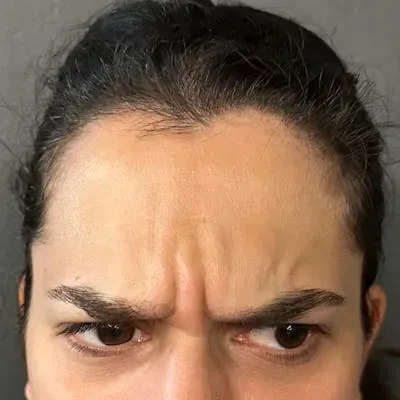 Botox #1 before