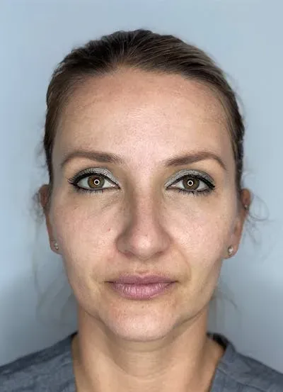 Chemical Peels #2 before