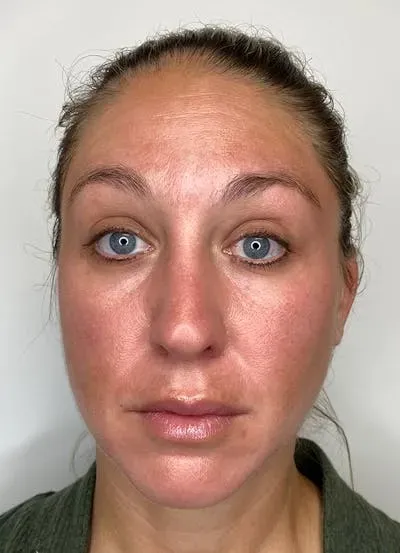 Chemical Peels #1 after