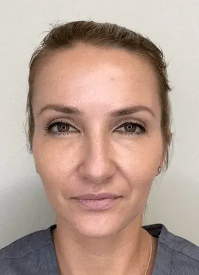 Chemical Peels #2 after