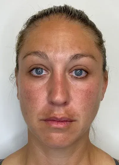 Chemical Peels #1 before