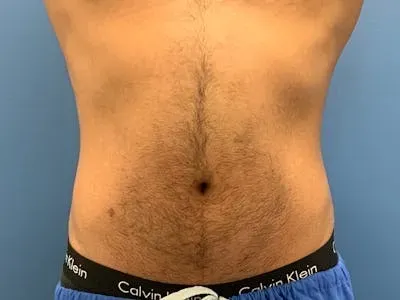 Cool Sculpting #1 before