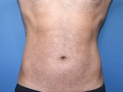 Cool Sculpting #1 after
