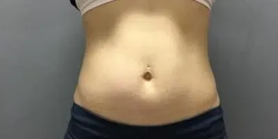 Emsculpt #1 before