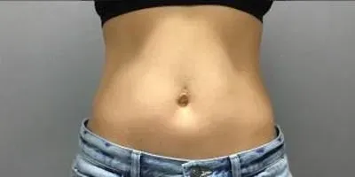 Emsculpt #1 after