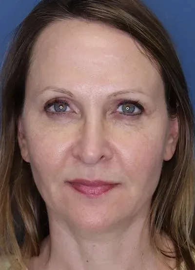 Halo Skin Resurfacing #13 after