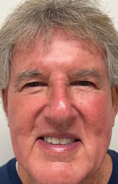 Halo Skin Resurfacing #1 after