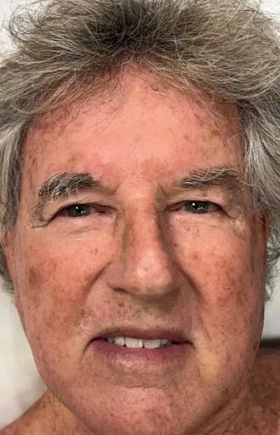 Halo Skin Resurfacing #1 before