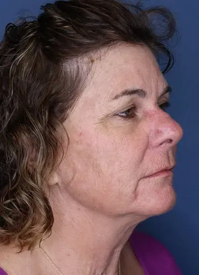 Halo Skin Resurfacing #12 after