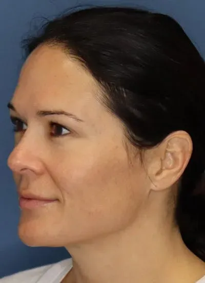 Halo Skin Resurfacing #5 after