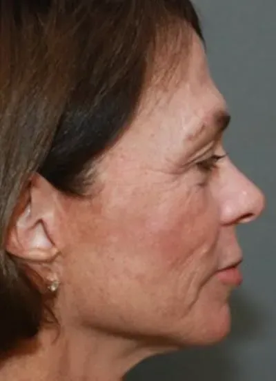 Halo Skin Resurfacing #9 after