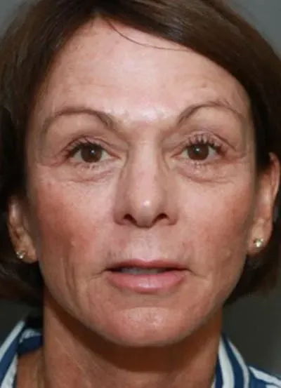 Halo Skin Resurfacing #8 after