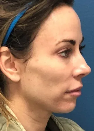 Halo Skin Resurfacing #4 before
