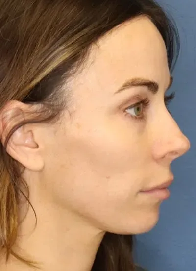 Halo Skin Resurfacing #4 after