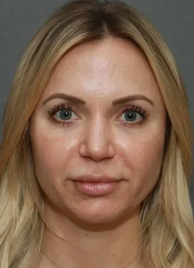 Halo Skin Resurfacing #15 after