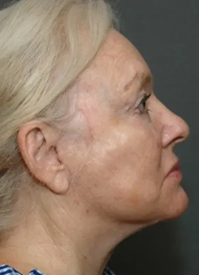 Halo Skin Resurfacing #3 after