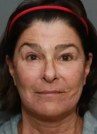Halo Skin Resurfacing #14 after