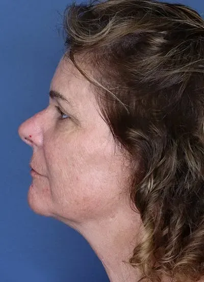 Halo Skin Resurfacing #11 after