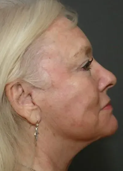 Halo Skin Resurfacing #3 before