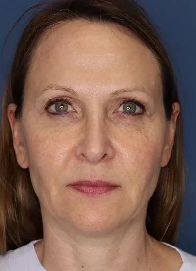 Halo Skin Resurfacing #13 before