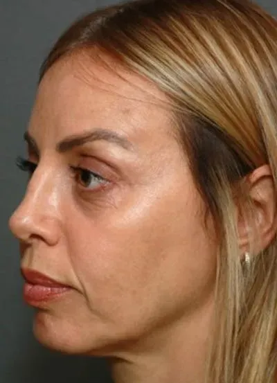 Halo Skin Resurfacing #7 before