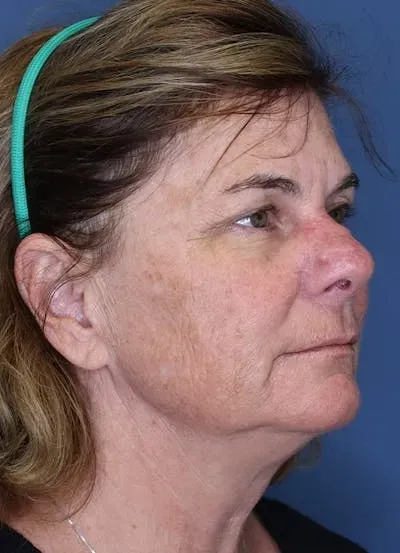 Halo Skin Resurfacing #12 before