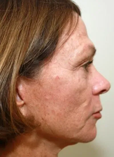Halo Skin Resurfacing #9 before