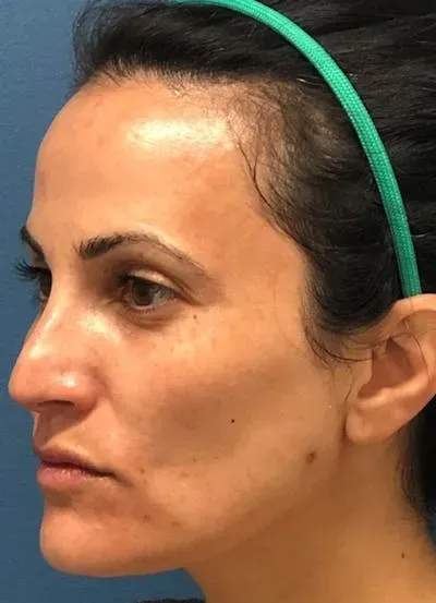 Halo Skin Resurfacing #6 before