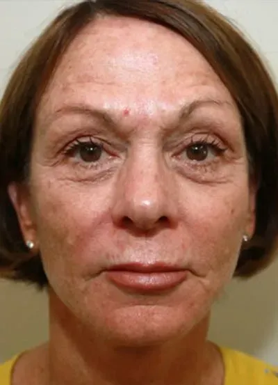 Halo Skin Resurfacing #8 before