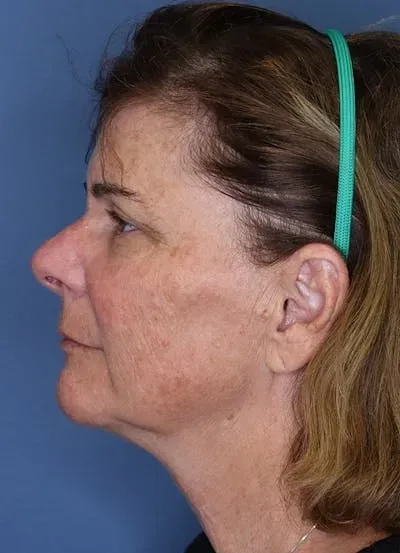 Halo Skin Resurfacing #11 before