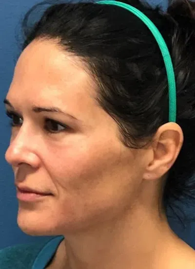 Halo Skin Resurfacing #5 before