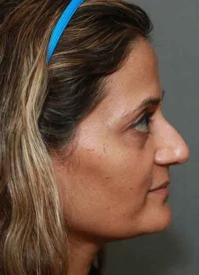 Halo Skin Resurfacing #10 before