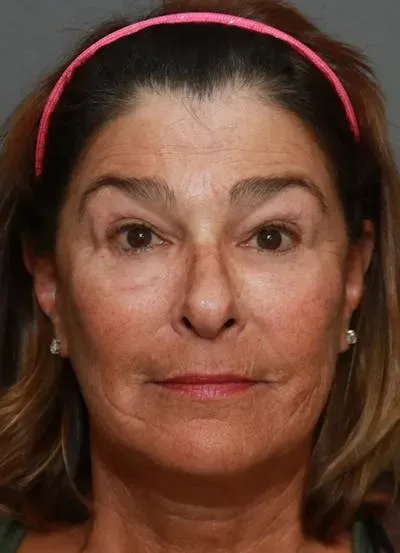 Halo Skin Resurfacing #14 before