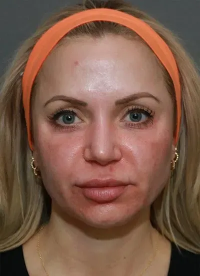Halo Skin Resurfacing #15 before