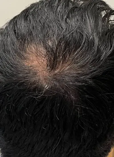 Keravive Scalp Treatment #1 after