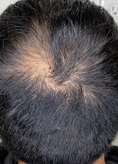 Keravive Scalp Treatment #1 before