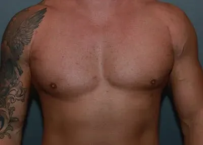 Gynecomastia #15 after